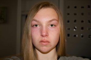 fracture du nez après 4 semaines